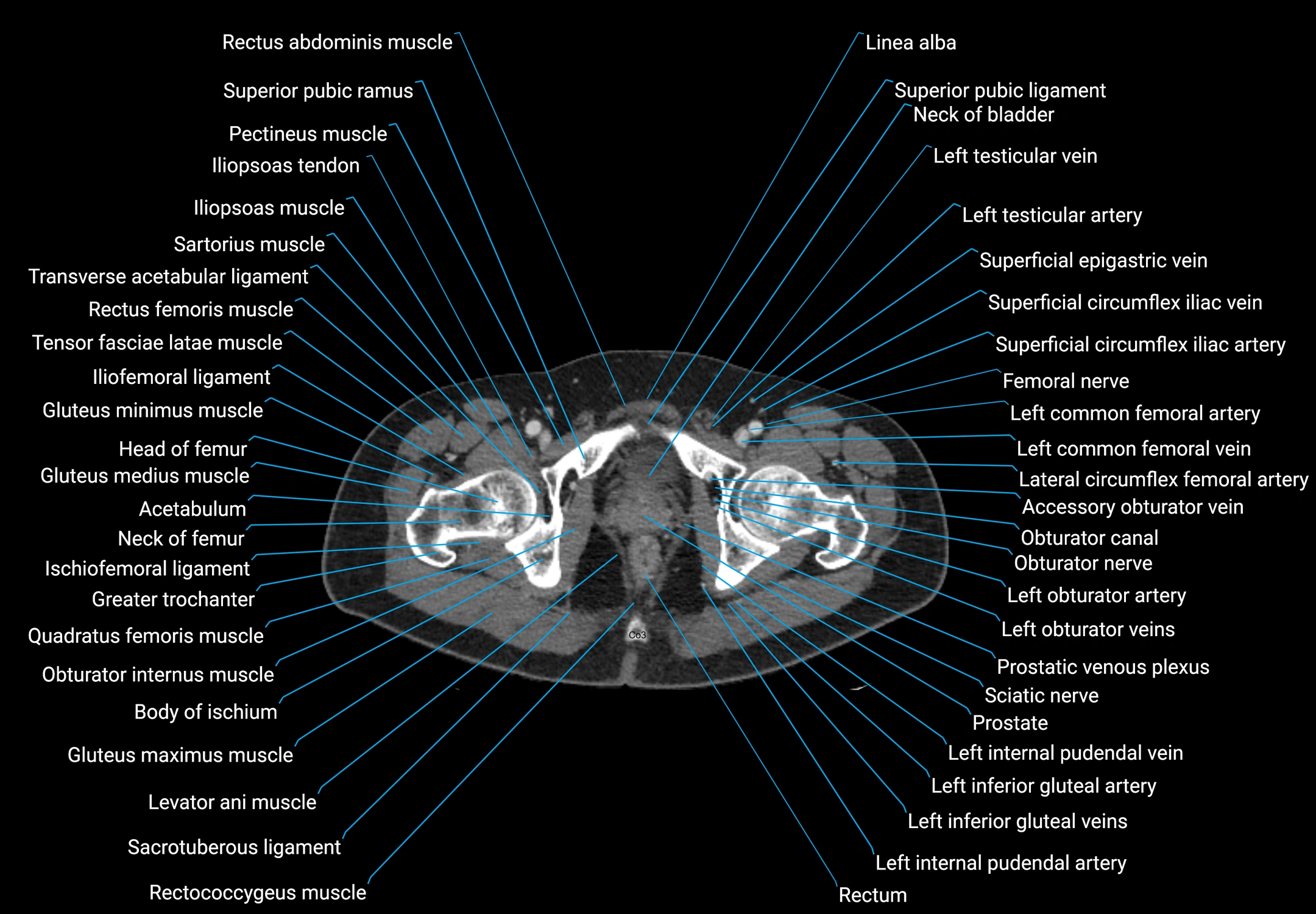 CT male pelvis axial cross sectional anatomy labelled radiology image -00194.webp